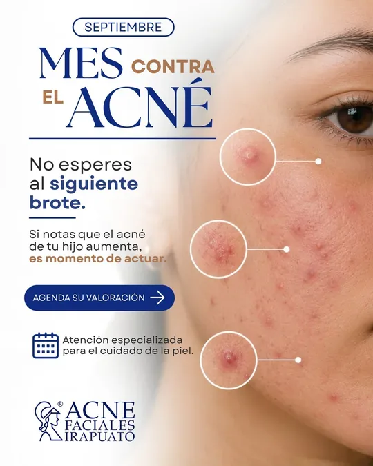 Acné Faciales · foto 4